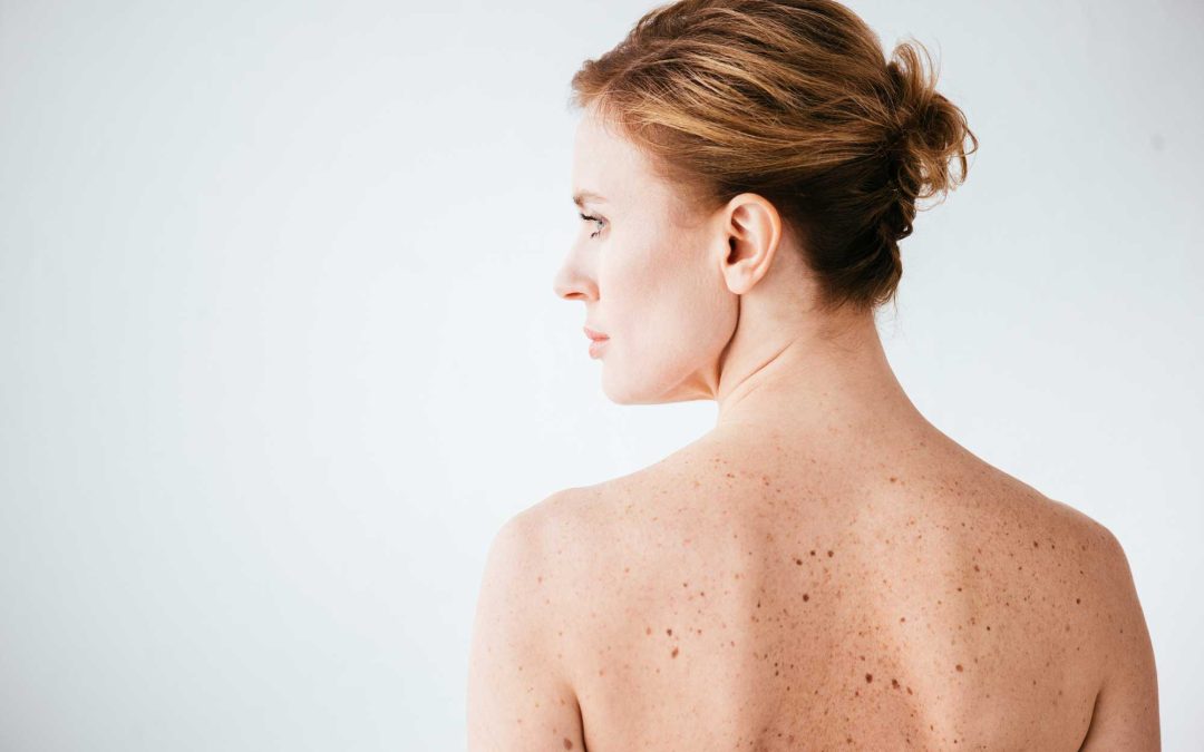 Five Early Signs of Skin Cancer You Should Never Ignore