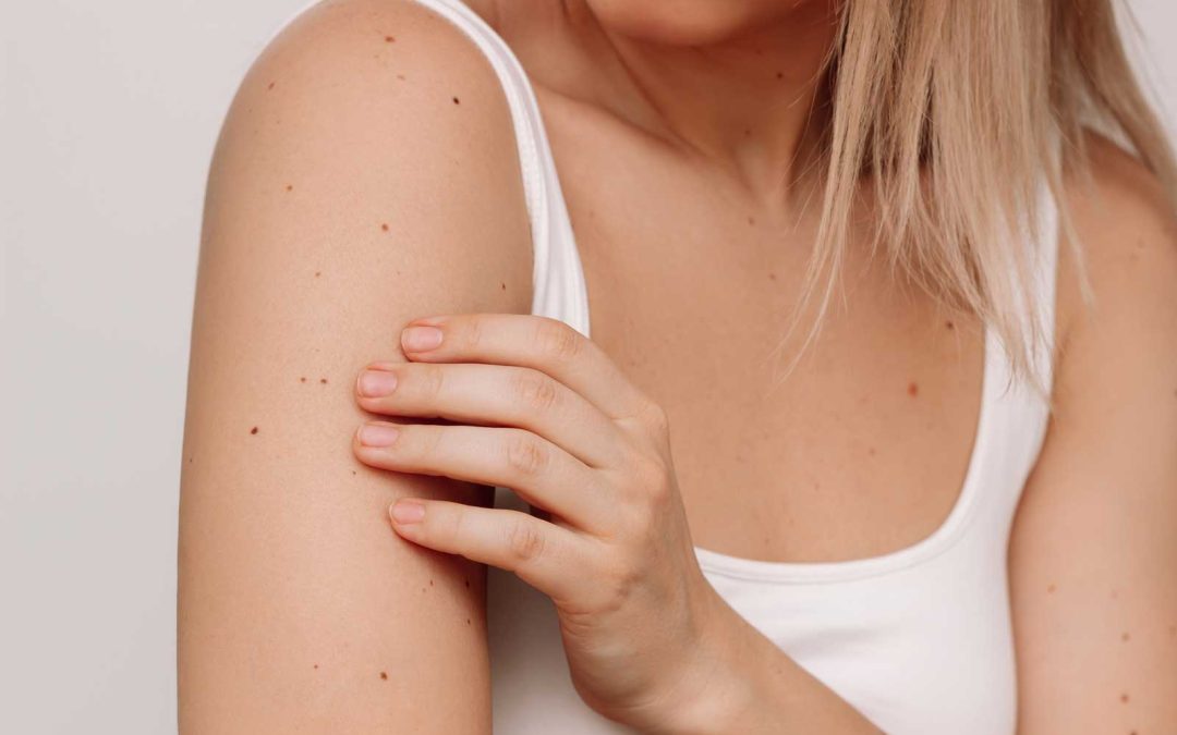 How to Perform a Self Skin Check Using the SCAN Framework